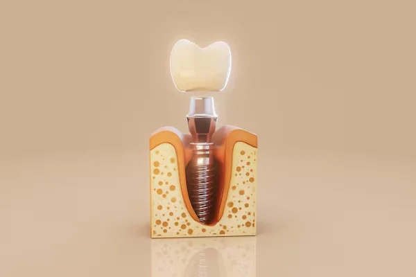 Dental Implants