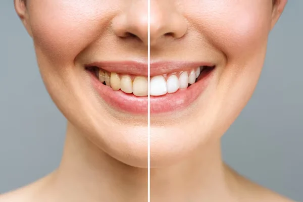 Teeth Whitening