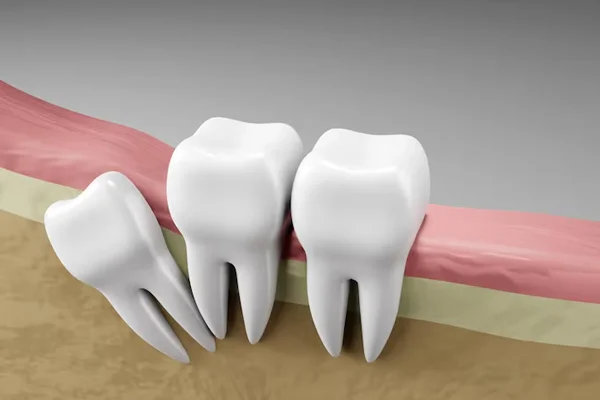 Wisdom Tooth Removal